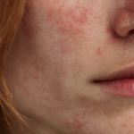 dermatita periorală