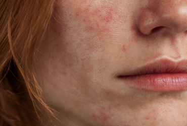 dermatita periorală